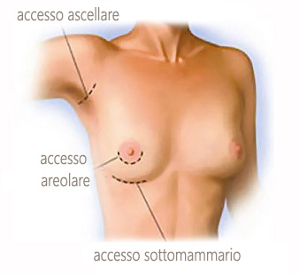 mastoplastica additiva accessi chirurgici