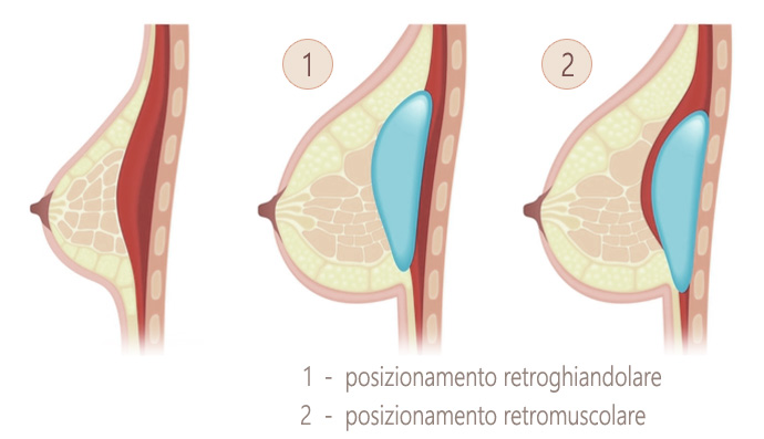 Msatoplastica additiva posizionamento delle protesi